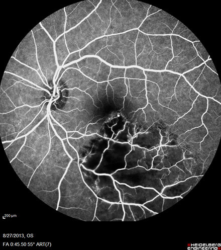 Branch Retinal Vein Occlusion