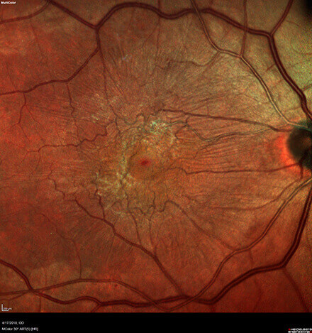 Epi-Retinal Membrane photo