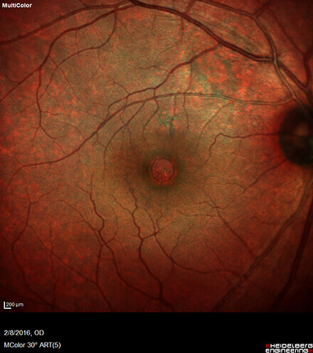 Retinal photo showing macular hole