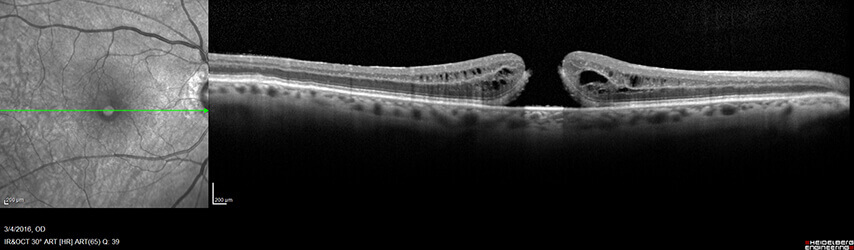 Image of a Macular Hole taken with Optical Coherence Tomography (OCT)