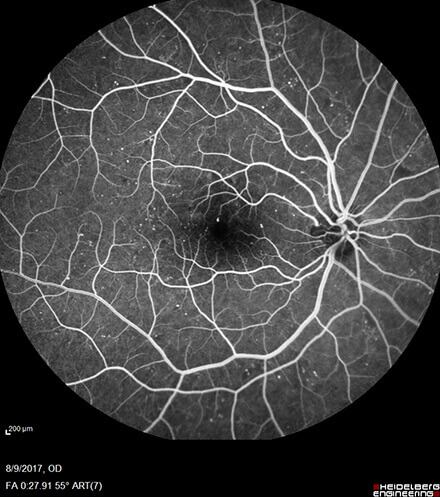 Non-Proliferative Diabetic Retinopathy