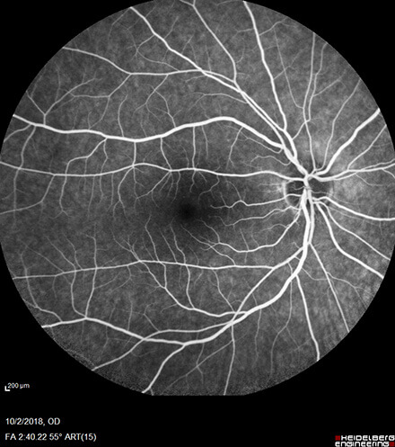 Normal Retina