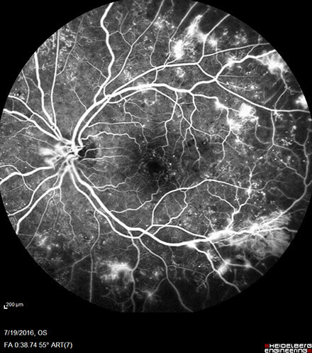 Proliferative Diabetic Retinopathy