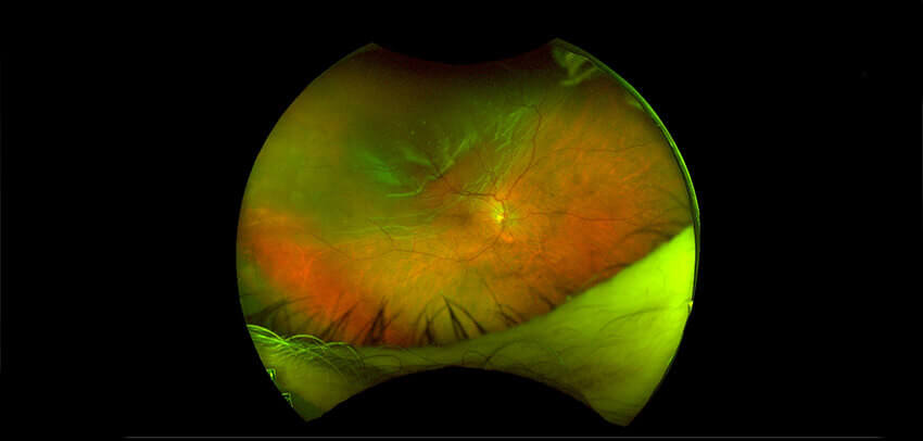 retinal detachment vision