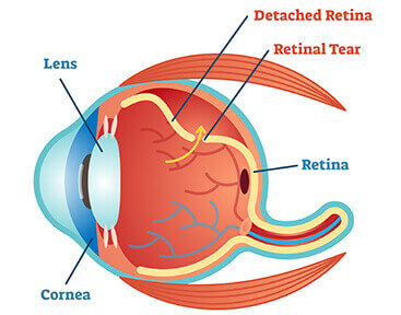 Retinal Tear Diagram